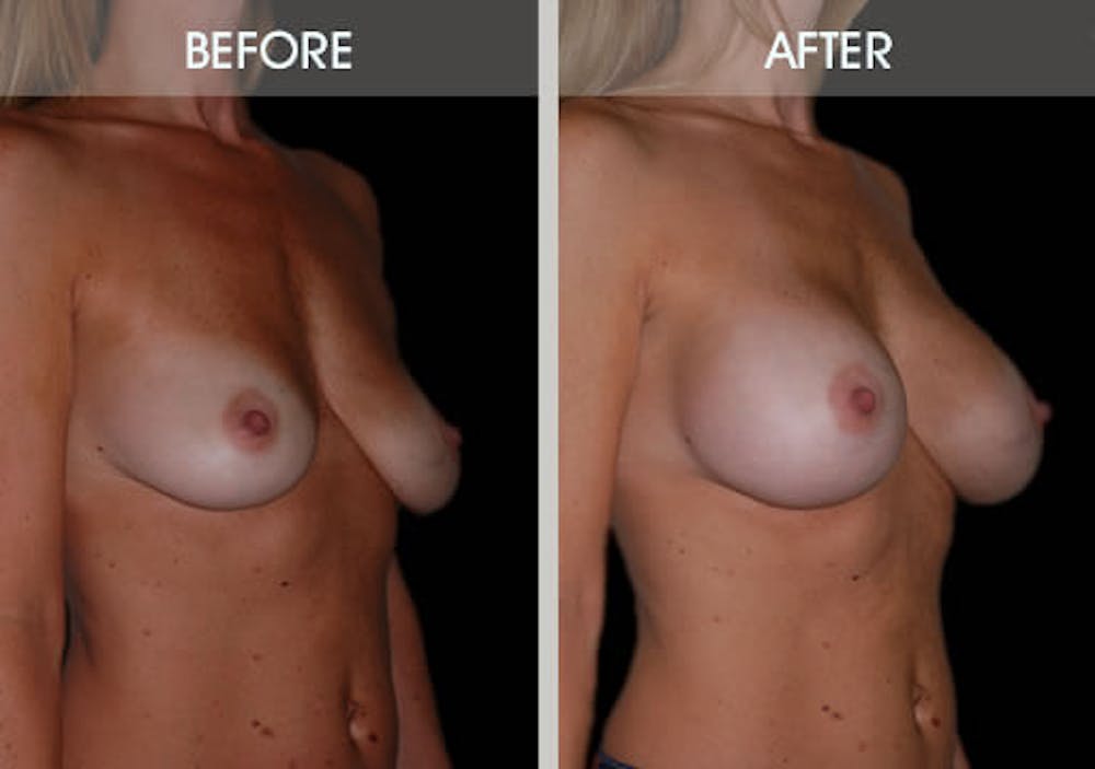 Breast Augmentation Gallery Before & After Gallery - Patient 2207164 - Image 3