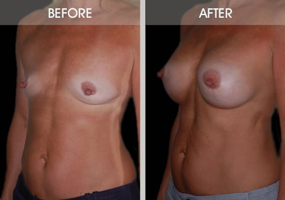 Breast Augmentation Gallery Before & After Gallery - Patient 2207165 - Image 2