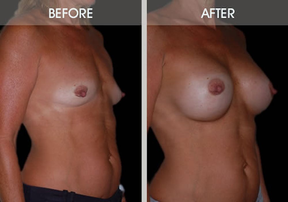 Breast Augmentation Gallery Before & After Gallery - Patient 2207165 - Image 3