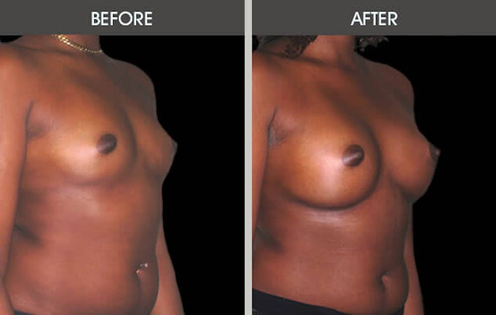 Breast Augmentation Gallery Before & After Gallery - Patient 2207167 - Image 2