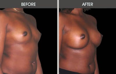 Breast Augmentation Before & After Gallery - Patient 2207167 - Image 2