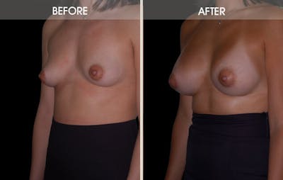 Breast Augmentation Before & After Gallery - Patient 2207171 - Image 2