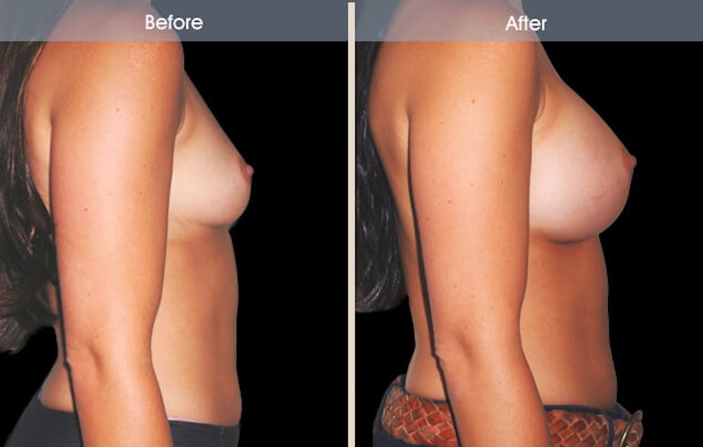 Breast Augmentation Gallery Before & After Gallery - Patient 2207174 - Image 2