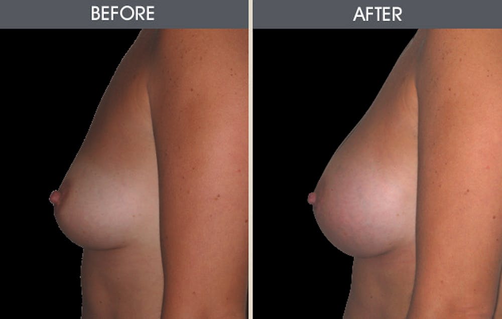 Breast Augmentation Before & After Gallery - Patient 2207177 - Image 2