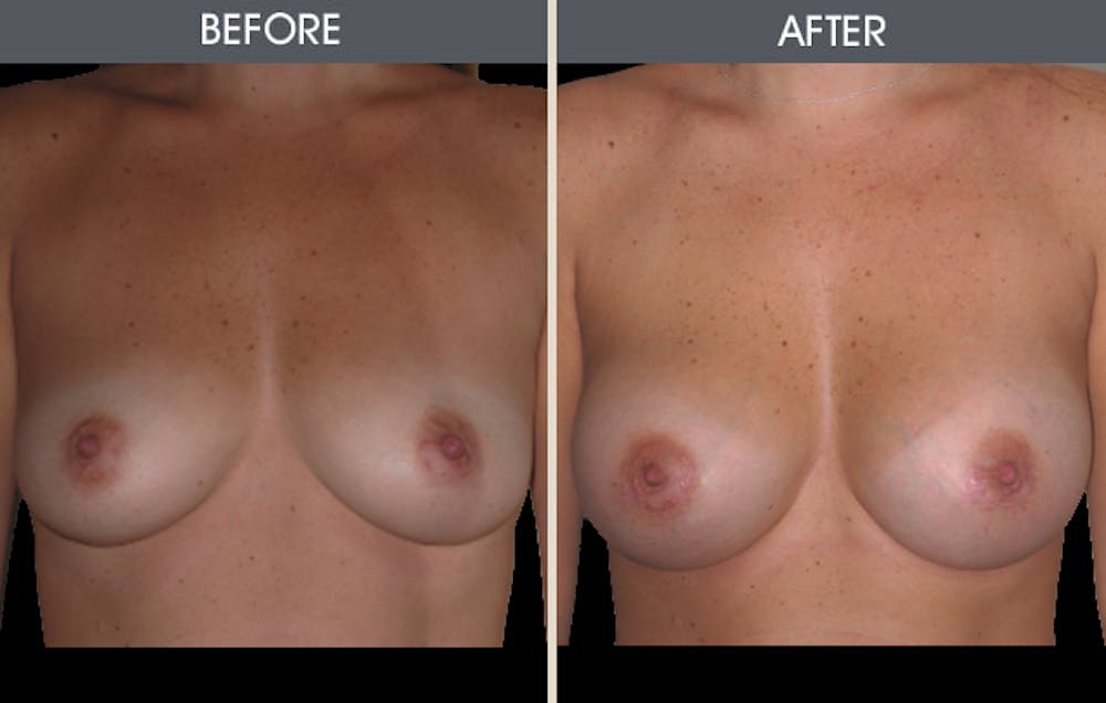 Breast Augmentation Gallery Before & After Gallery - Patient 2207177 - Image 3