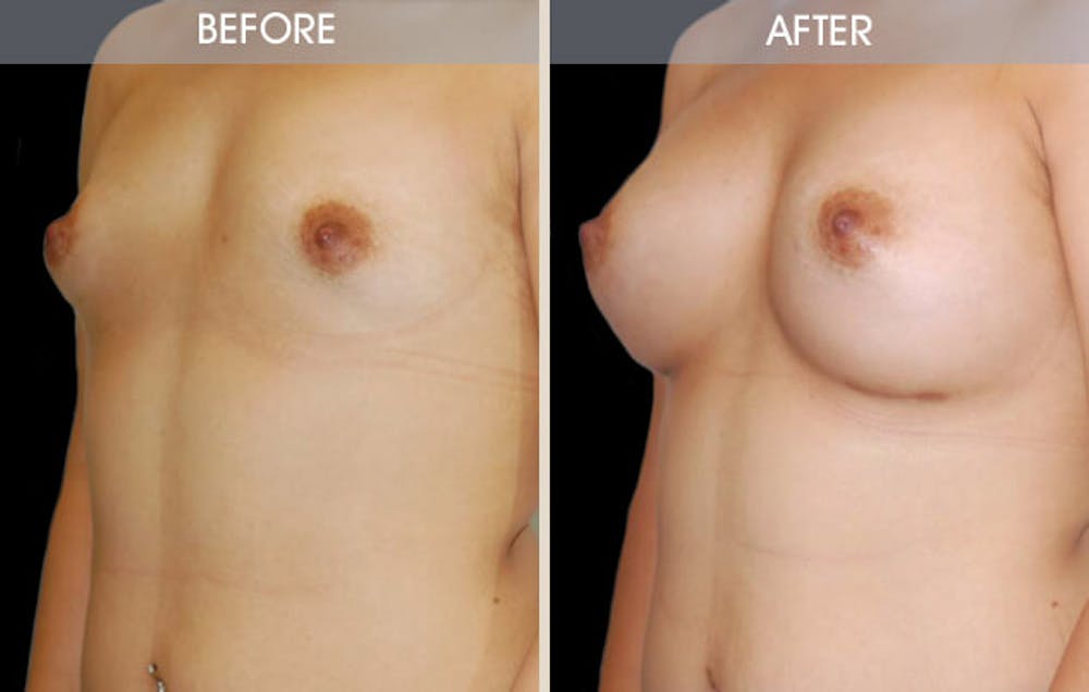 Breast Augmentation Gallery Before & After Gallery - Patient 2207180 - Image 2