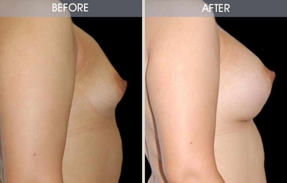 Breast Augmentation Gallery Before & After Gallery - Patient 2207180 - Image 3