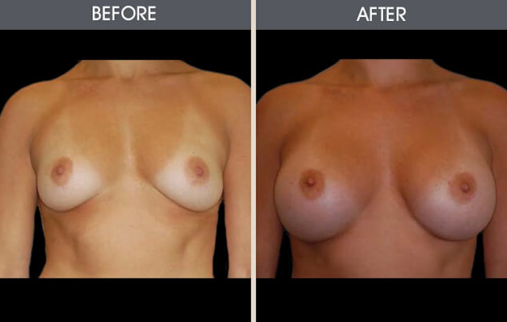 Breast Augmentation Gallery Before & After Gallery - Patient 2207181 - Image 2