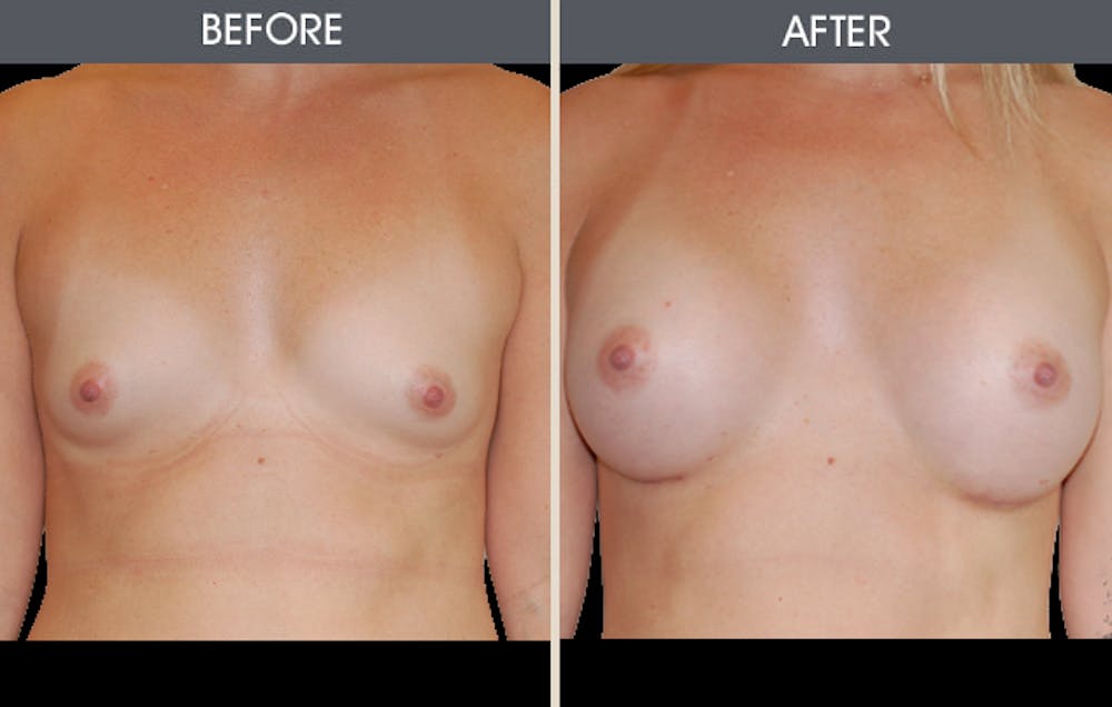 Breast Augmentation Gallery Before & After Gallery - Patient 2207184 - Image 2