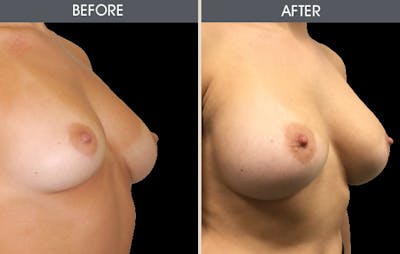 Breast Augmentation Before & After Gallery - Patient 2207207 - Image 2