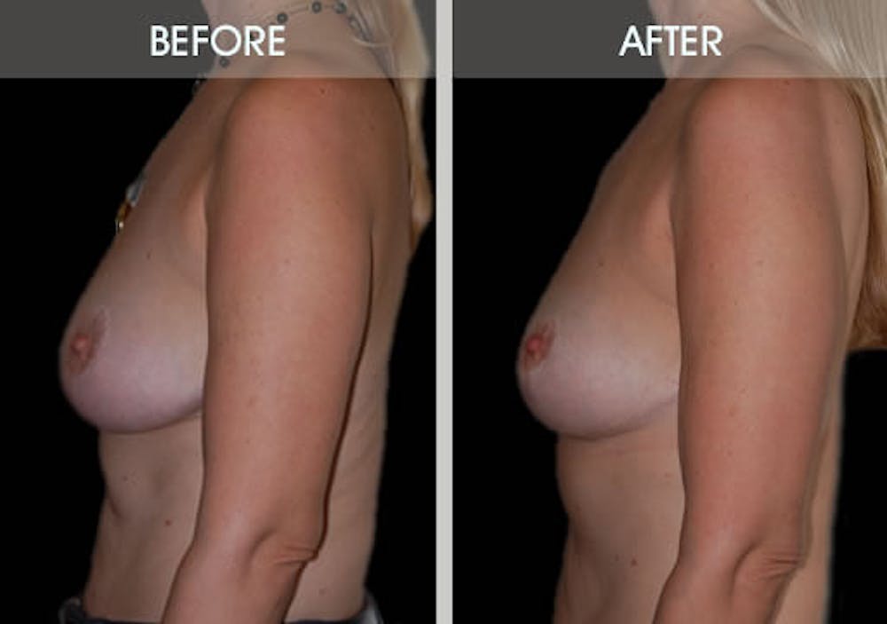 Breast Lift Before & After Gallery - Patient 2207166 - Image 2