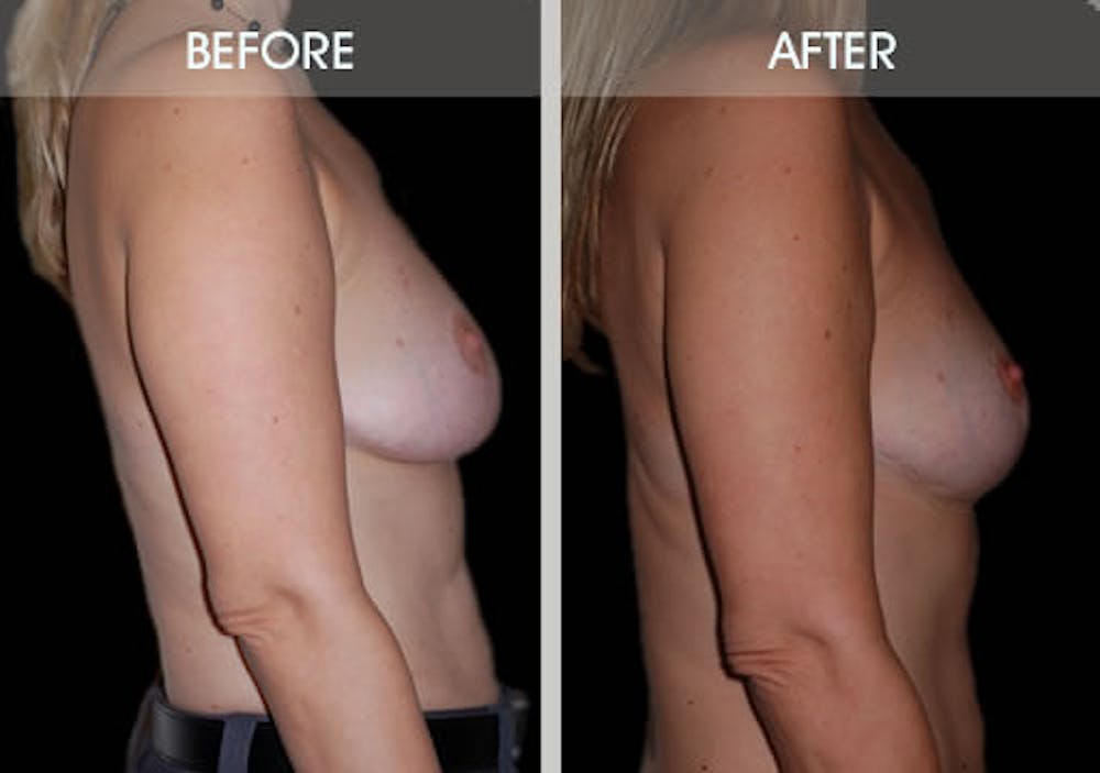 Breast Lift Before & After Gallery - Patient 2207166 - Image 3