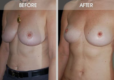 Breast Lift Gallery Before & After Gallery - Patient 2207166 - Image 4