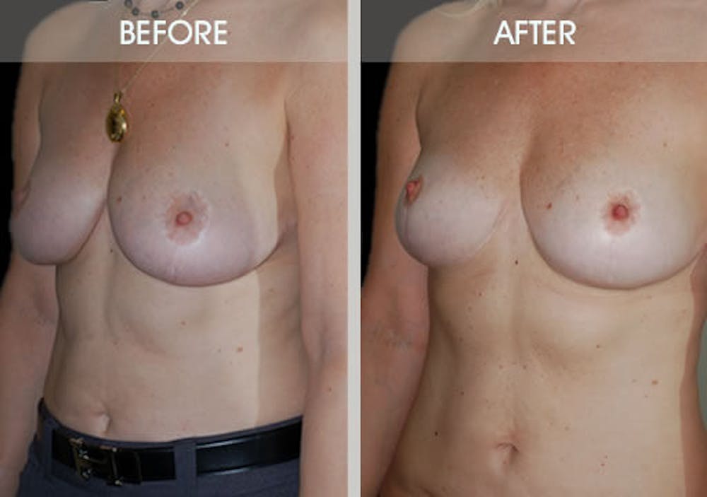 Breast Lift Before & After Gallery - Patient 2207166 - Image 4