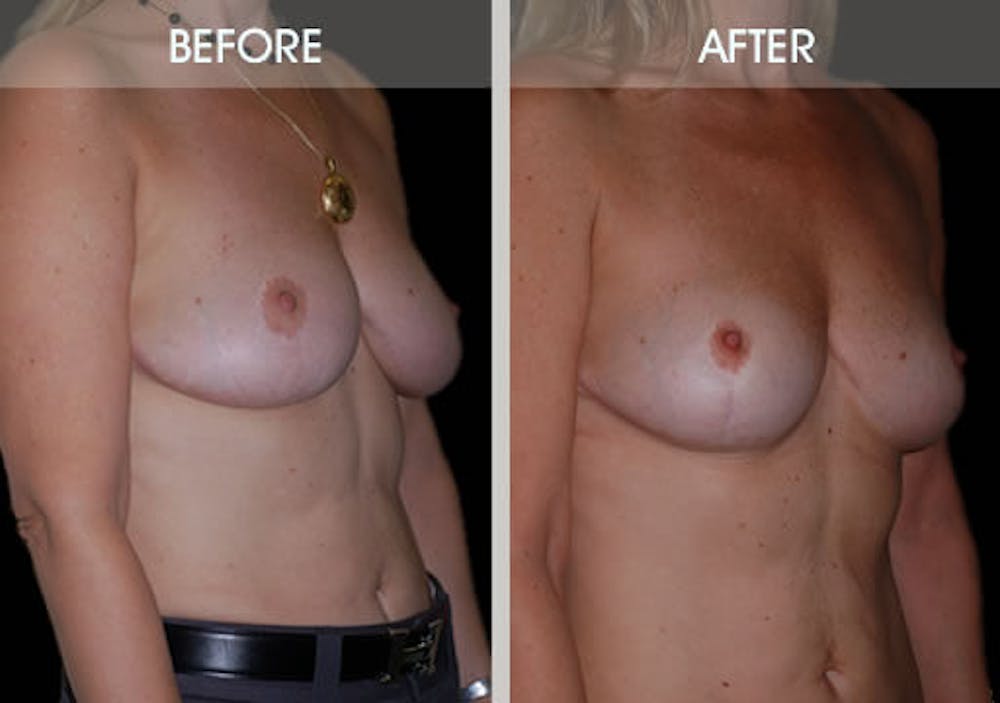 Breast Lift Gallery Before & After Gallery - Patient 2207166 - Image 5