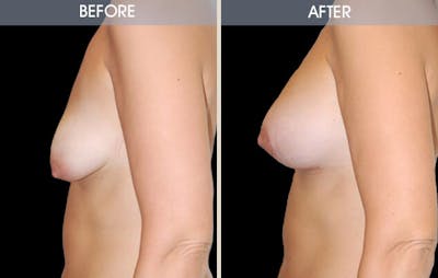 Breast Lift Before & After Gallery - Patient 2207172 - Image 2