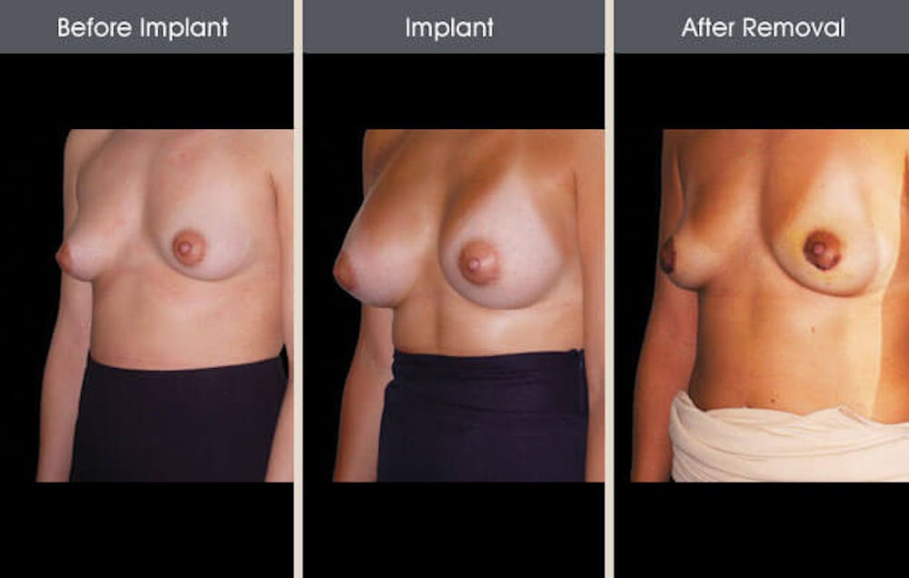 Breast Implant Removal Gallery Before & After Gallery - Patient 2207173 - Image 2