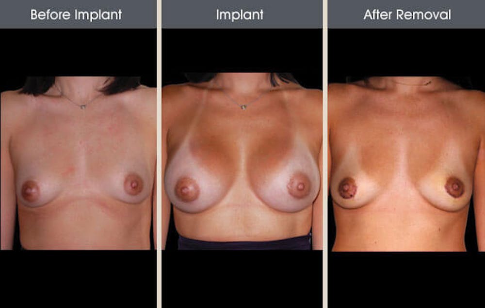 Breast Implant Removal Gallery Before & After Gallery - Patient 2207173 - Image 3