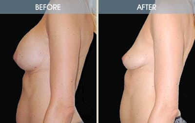 Breast Implant Removal Before & After Gallery - Patient 2207176 - Image 2
