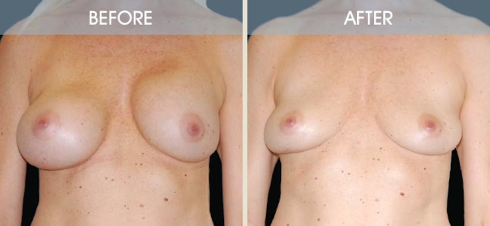 Breast Implant Removal Gallery Before & After Gallery - Patient 2207176 - Image 3