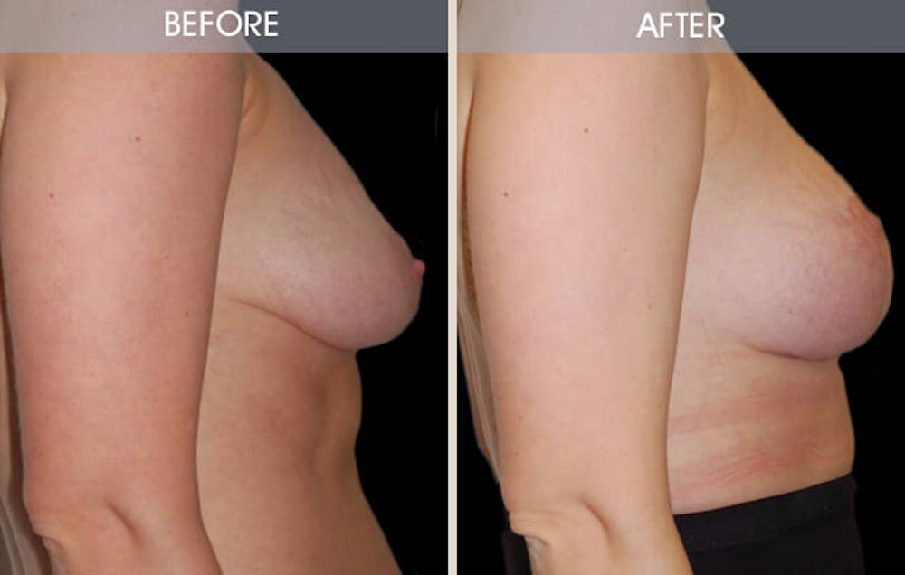 Breast Reconstruction Before & After Gallery - Patient 2207187 - Image 2