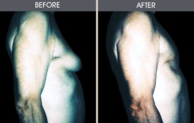 Male Breast Reduction (Gynecomastia) Gallery Before & After Gallery - Patient 2207216 - Image 2