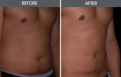 Liposuction Gallery - Patient 2207212 - Image 2