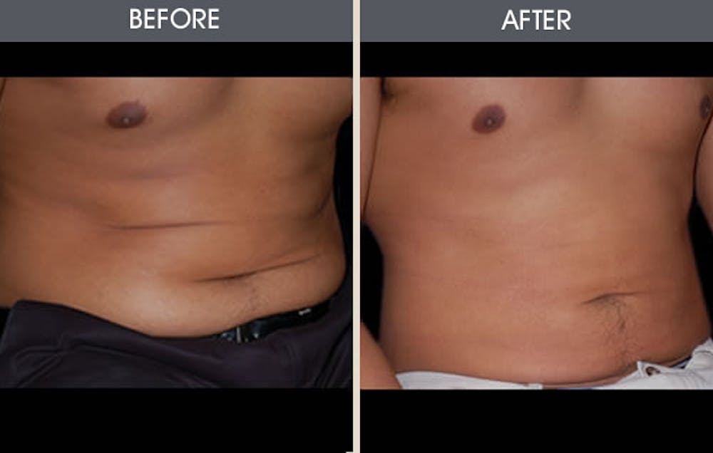 Liposuction Gallery Before & After Gallery - Patient 2207212 - Image 3