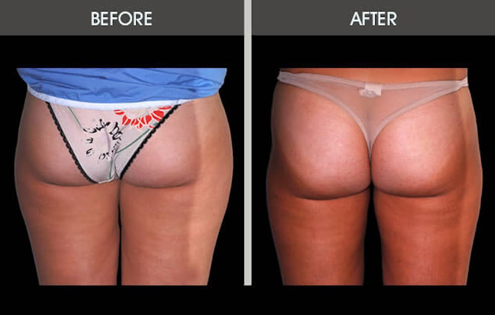 Liposuction Before & After Gallery - Patient 2207222 - Image 2