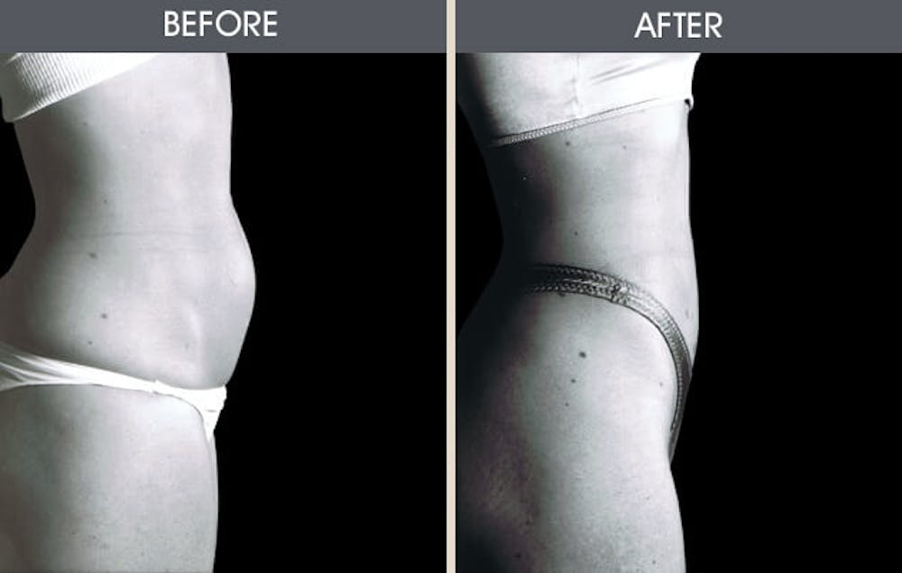 Liposuction Gallery Before & After Gallery - Patient 2207234 - Image 2