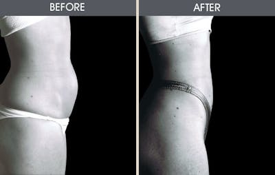 Liposuction Gallery Before & After Gallery - Patient 2207234 - Image 2