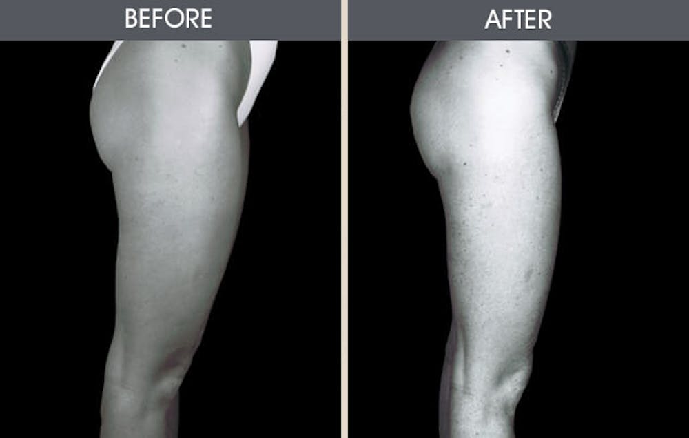 Liposuction Gallery Before & After Gallery - Patient 2207234 - Image 3