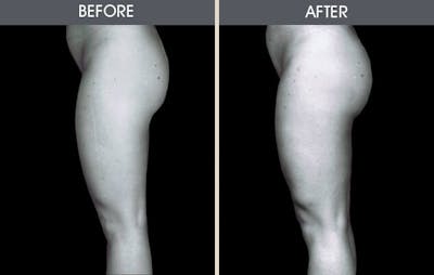 Liposuction Gallery Before & After Gallery - Patient 2207234 - Image 4