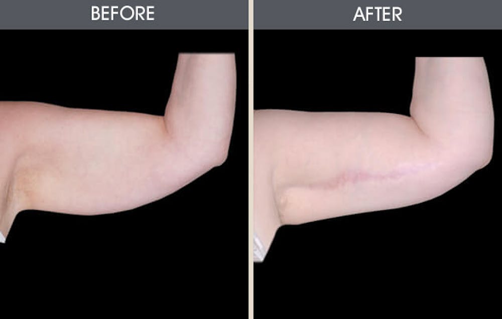Before and After of patient's triceps.