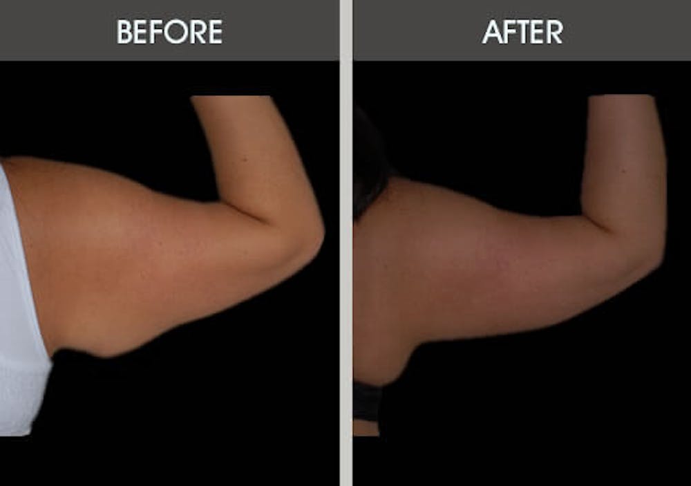 Before and After of patient's triceps.