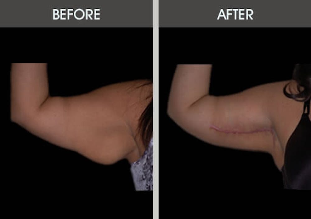 Arm Lift (Brachioplasty) Gallery Before & After Gallery - Patient 2207245 - Image 3
