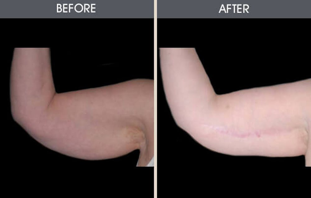 Arm Lift (Brachioplasty) Gallery Before & After Gallery - Patient 2207247 - Image 2