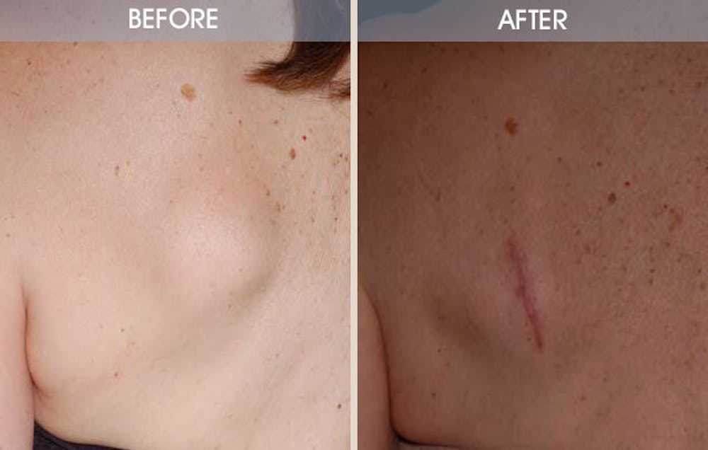 Lipoma Removal Before & After Gallery - Patient 2207392 - Image 2