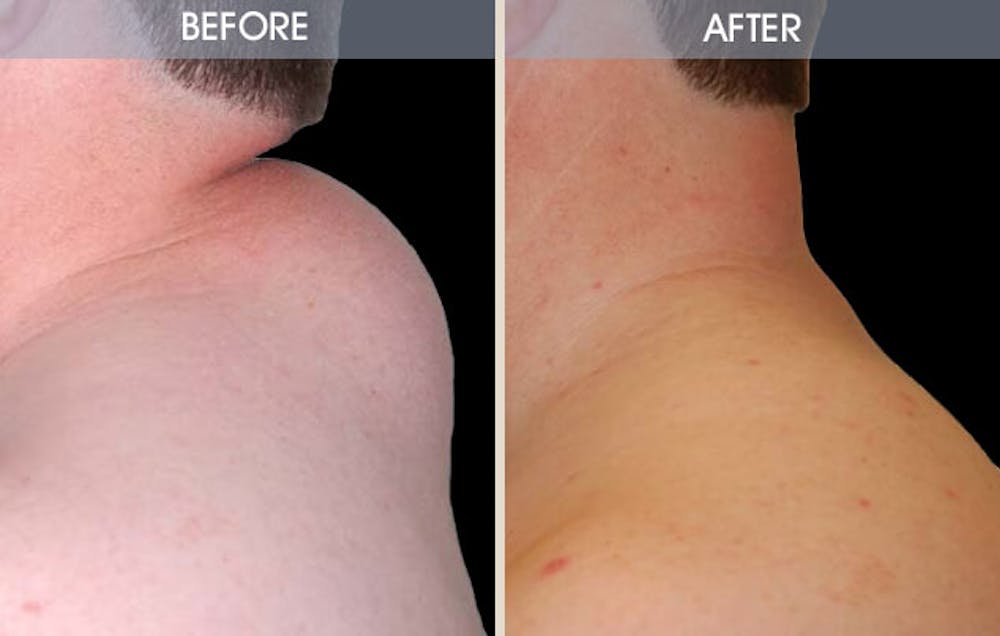 Lipoma Removal Before & After Gallery - Patient 2207403 - Image 2