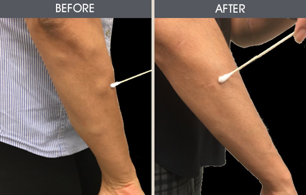 Lipoma Removal Before & After Gallery - Patient 2207524 - Image 2