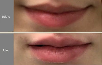 Fillers Before & After Gallery - Patient 2207491 - Image 2