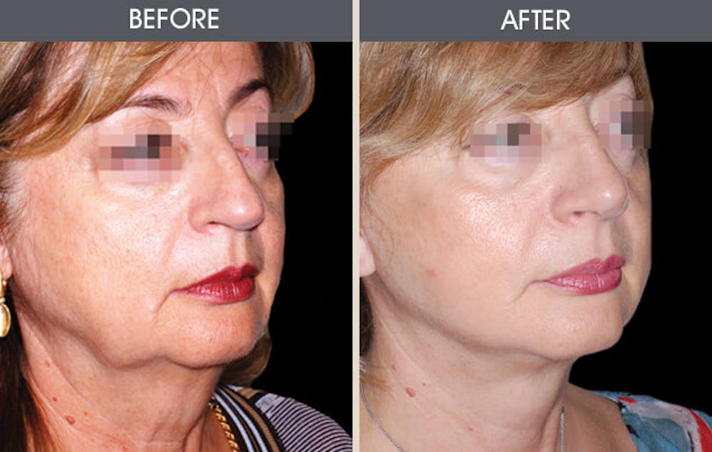 Facial Fat Transfer Gallery Before & After Gallery - Patient 2207556 - Image 2