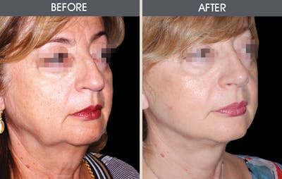 Facial Fat Transfer Gallery Before & After Gallery - Patient 2207556 - Image 2