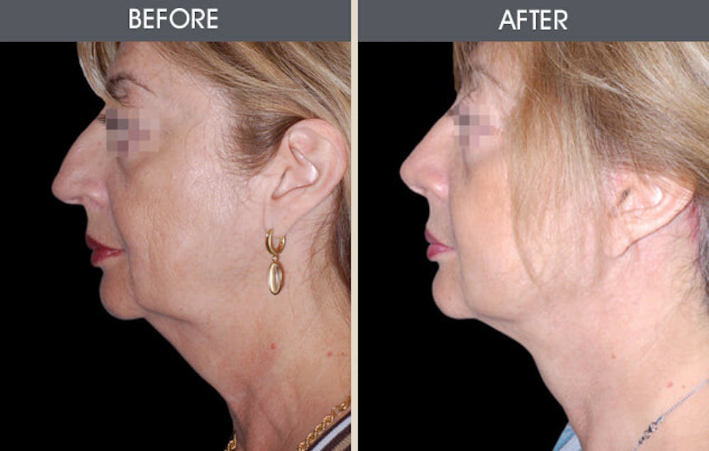 Facial Fat Transfer Gallery Before & After Gallery - Patient 2207556 - Image 3