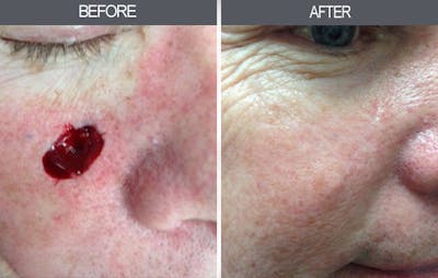 Skin Cancer Reconstruction Gallery Before & After Gallery - Patient 4446224 - Image 1