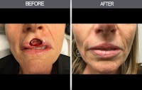 Skin Cancer Reconstruction Gallery Before & After Gallery - Patient 4446225 - Image 1