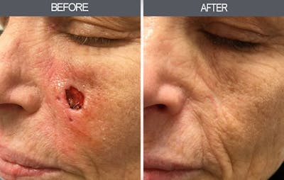 Skin Cancer Reconstruction Before & After Gallery - Patient 4446279 - Image 1