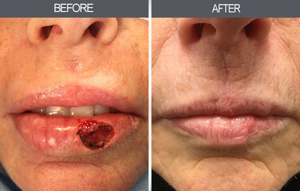 Skin Cancer Reconstruction Before & After Gallery - Patient 4446280 - Image 1