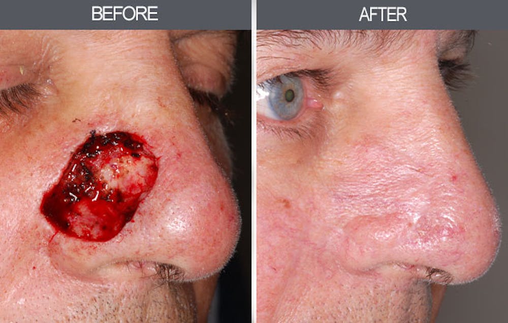 Skin Cancer Reconstruction Gallery Before & After Gallery - Patient 4446281 - Image 1