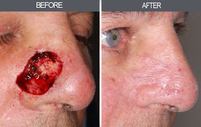 Skin Cancer Reconstruction Gallery Before & After Gallery - Patient 4446281 - Image 1